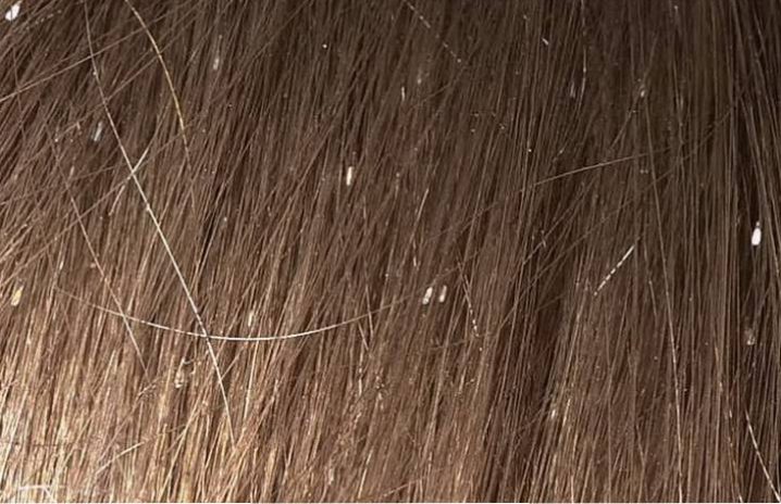 Гниды на волосах: фото, подробное описание и способы борьбы