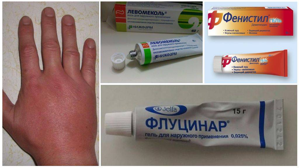 Аллерия на укусы комаров у детей и взрослых: симптомы и лечение