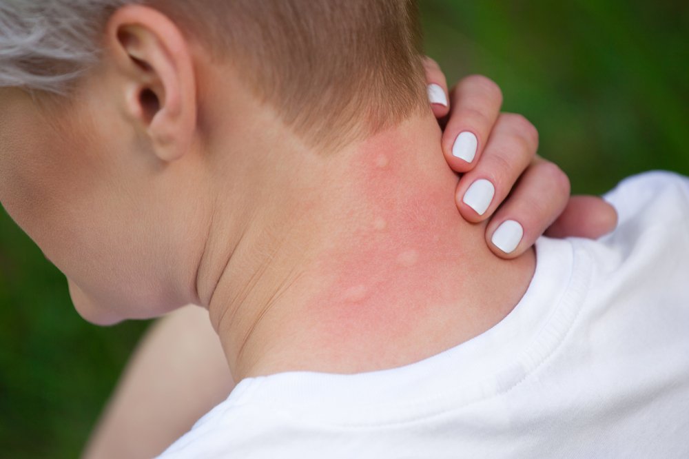 Холодовая аллергия: как проявляется реакция на холод, чем ее лечить