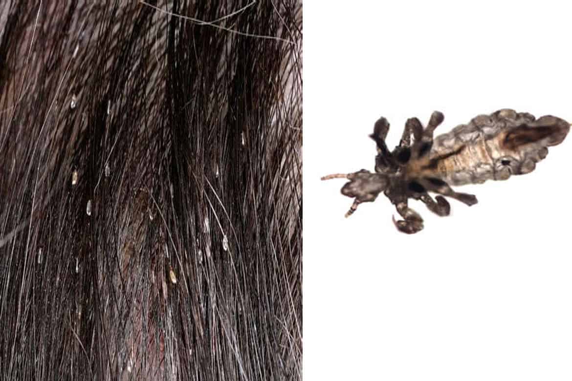 Головные вши и гниды в волосах: как выглядят, сколько живут вне головы + фото