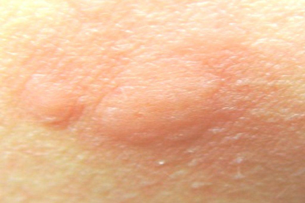 Сыпь после укуса клеща фото у человека