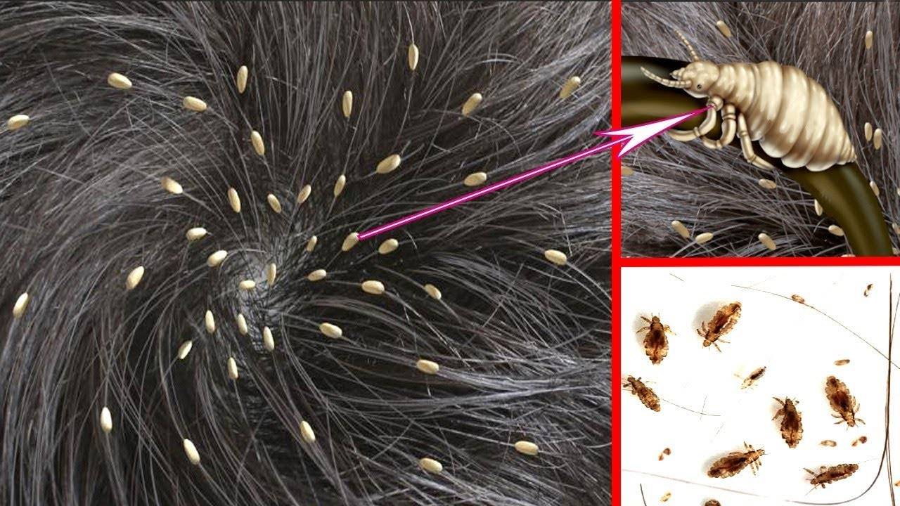 Чем и как вывести вшей и гнид у ребенка с длинными волосами: средства и методы лечения