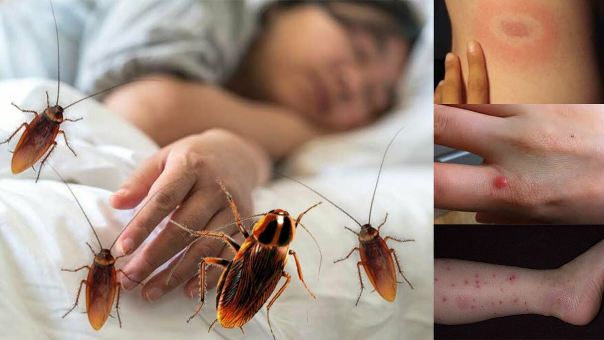 Кусают ли тараканы людей и как выглядит укус