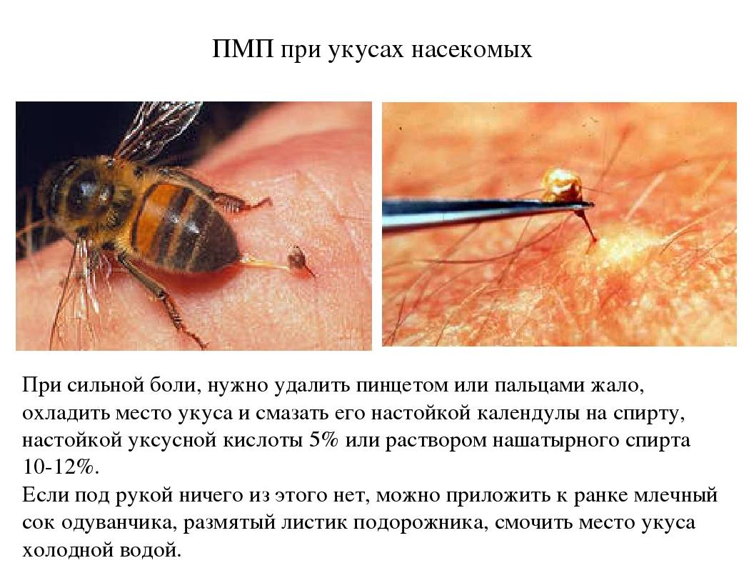 Аллергия на укусы насекомых: симптомы, лечение и диагностика