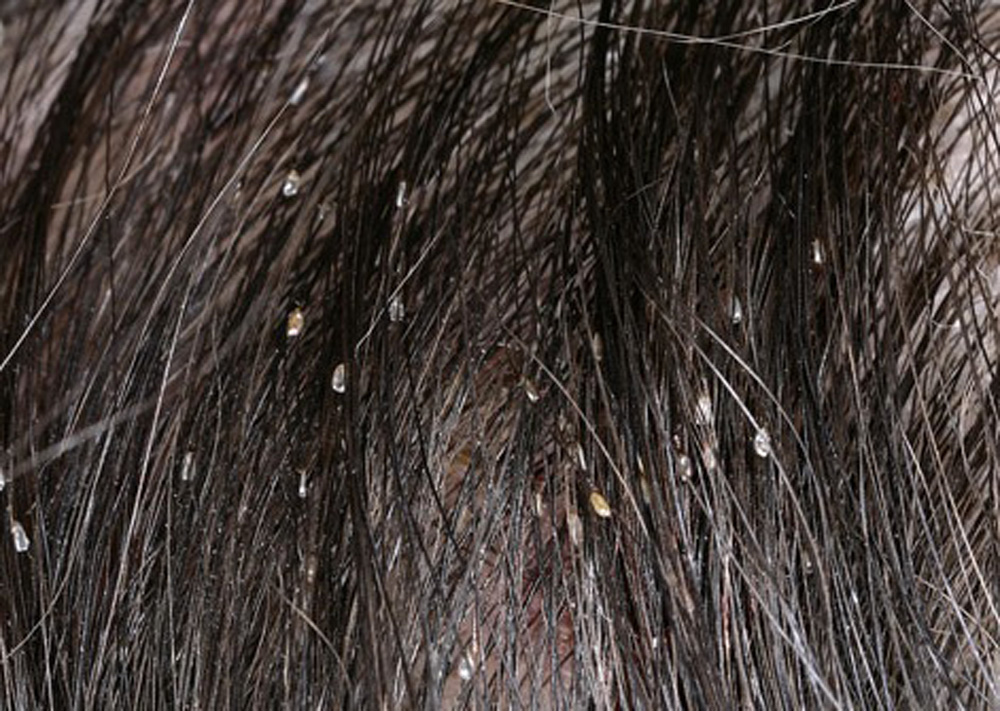 Как выглядят вши и гниды на волосах и как с ними бороться