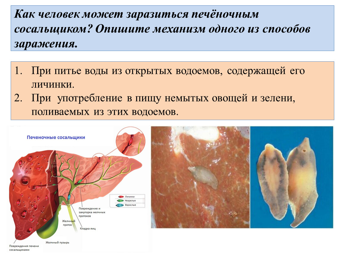 Описторхоз - симптомы болезни, профилактика и лечение описторхоза, причины заболевания и его диагностика на eurolab