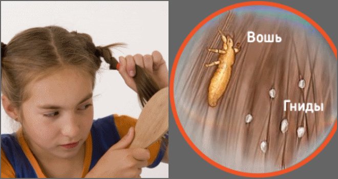 Как избавиться от вшей и гнид у детей: средства и лечение доктор комаровский вши и чесотка народные профилактические меры лекарственные шампуни