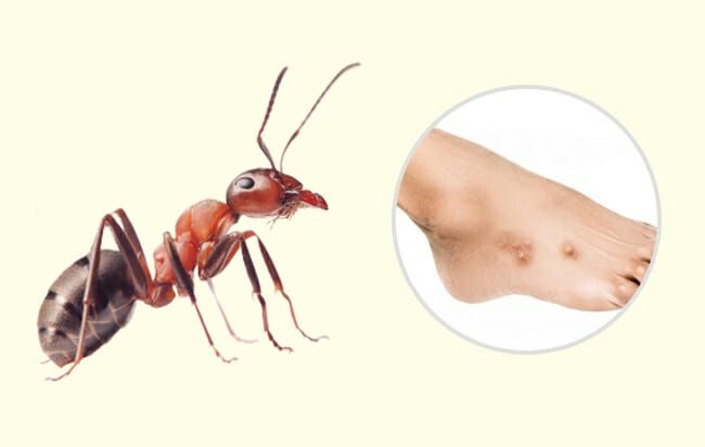 Укус муравья: как выглядит, симптомы, лечение