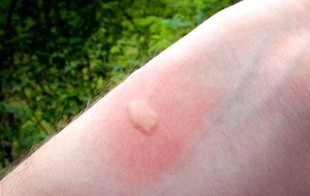 Сыпь, похожая на укусы комара и причины ее возникновения
