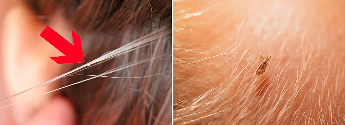Признаки вшей на голове: первые симптомы появления педикулеза, фото гнид у человека в волосах