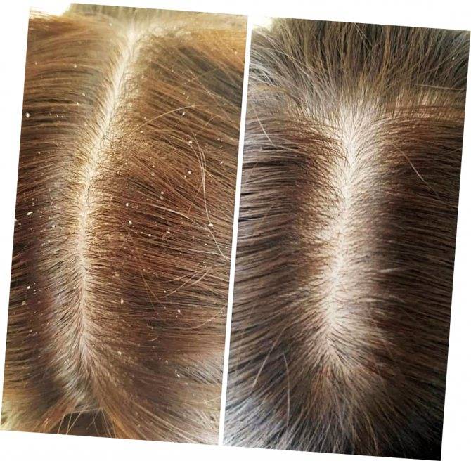 Как выглядят гниды на волосах у человека, какого они цвета и формы - ознакомительные фото