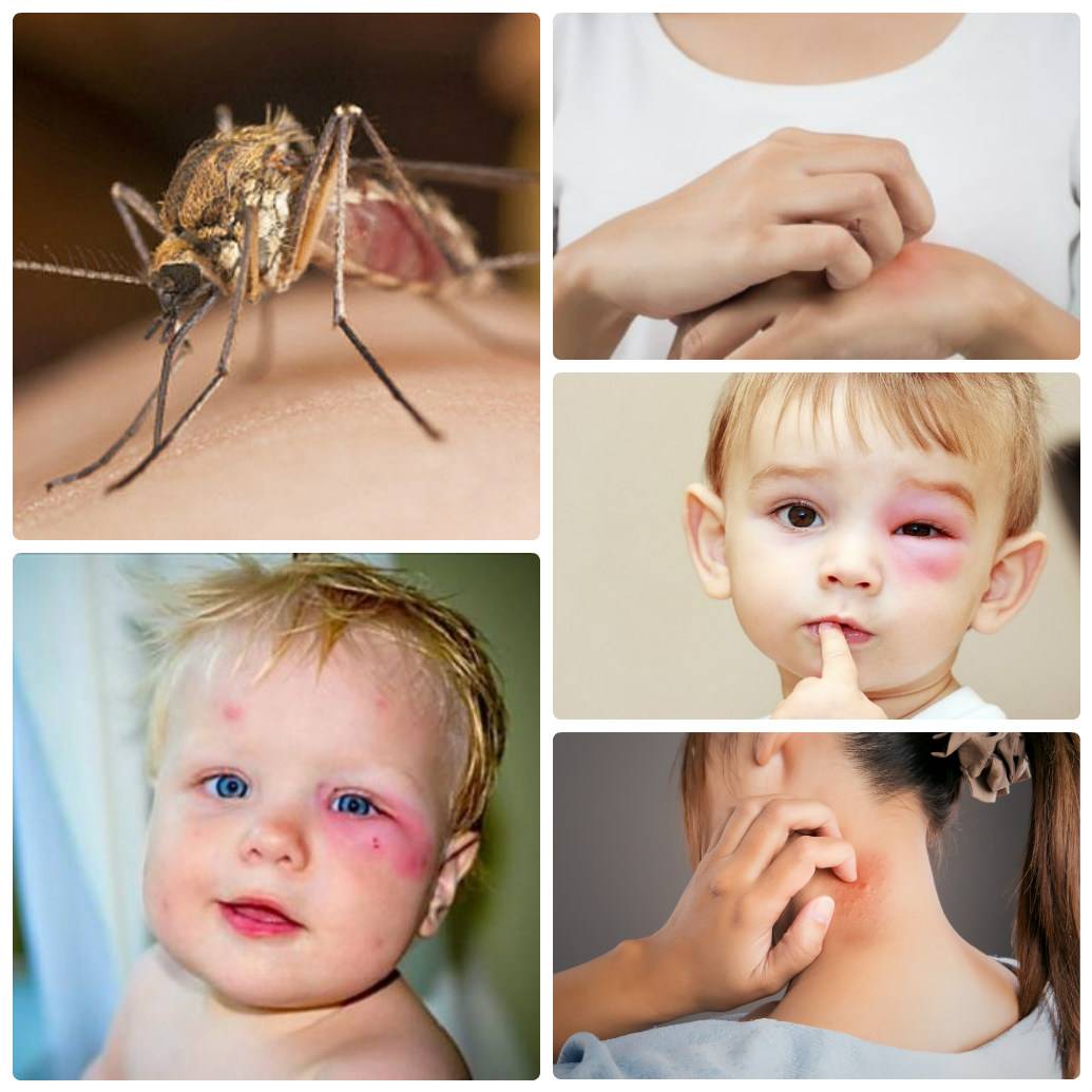 Нужно ли лечить укусы комаров у ребёнка и чем их мазать