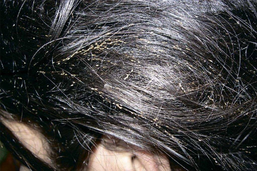 Живут ли вши на окрашенных волосах и может ли их убить краска для волос?