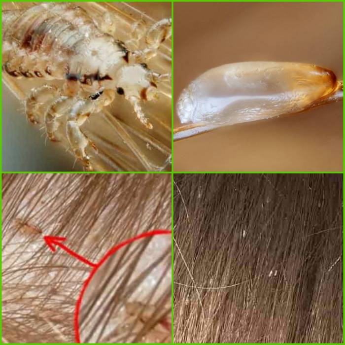 Живут ли вши под кожей головы человека. существует ли подкожная форма педикулеза? особенности и строение насекомых