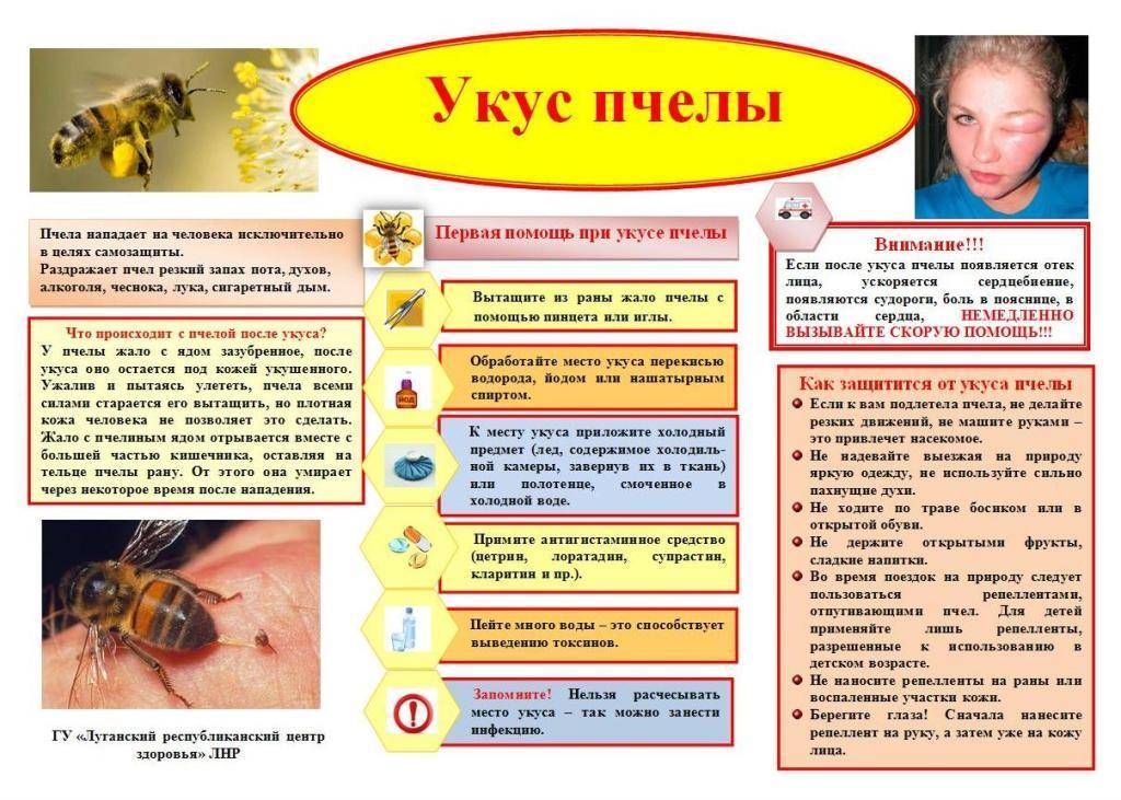 Укус пчелы: польза, вред, симптомы, первая помощь, лечение, народные средства
