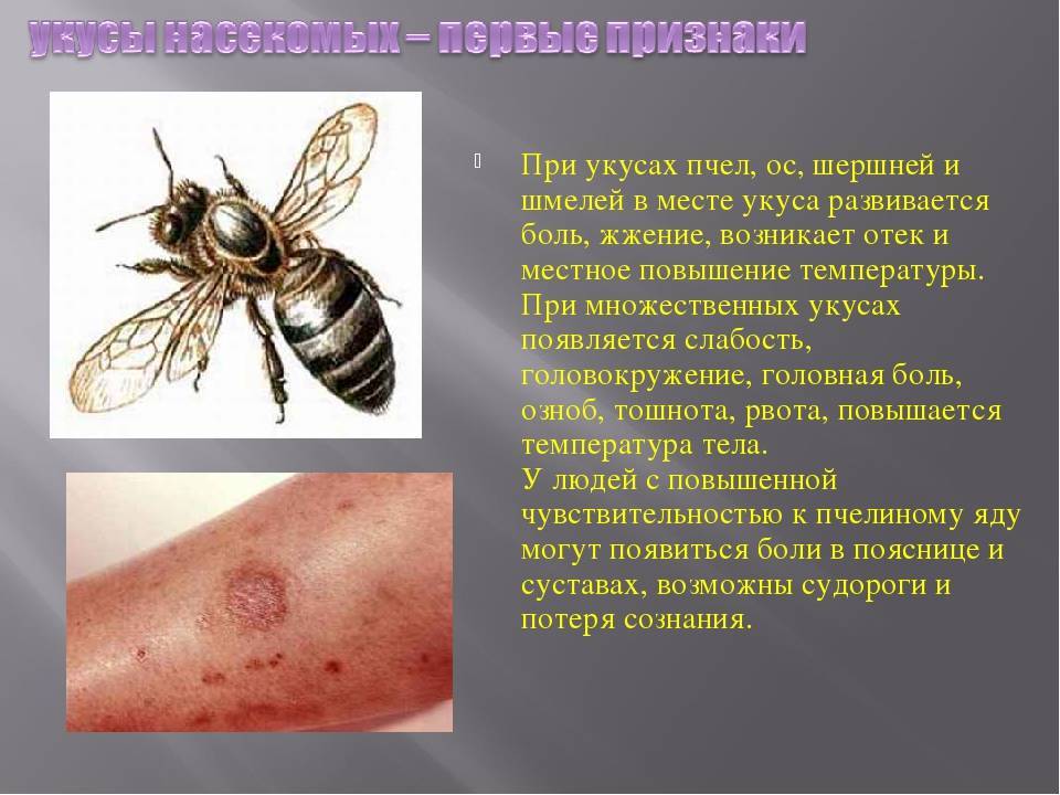 Ужалила пчела. как снять боль, опухоль и отек? как избавиться от последствий укуса пчелы? - здоровье прежде всего!