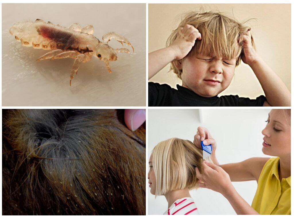 Что применить для борьбы с паразитами на голове: чего боятся вши и гниды?