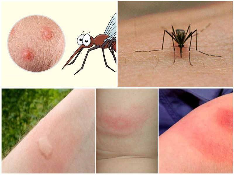 Чем помазать укусы комаров, чтобы не чесались и заживали