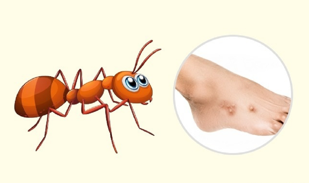 Укус муравья (рыжего, красного): фото и лечение / как избавится от насекомых в квартире