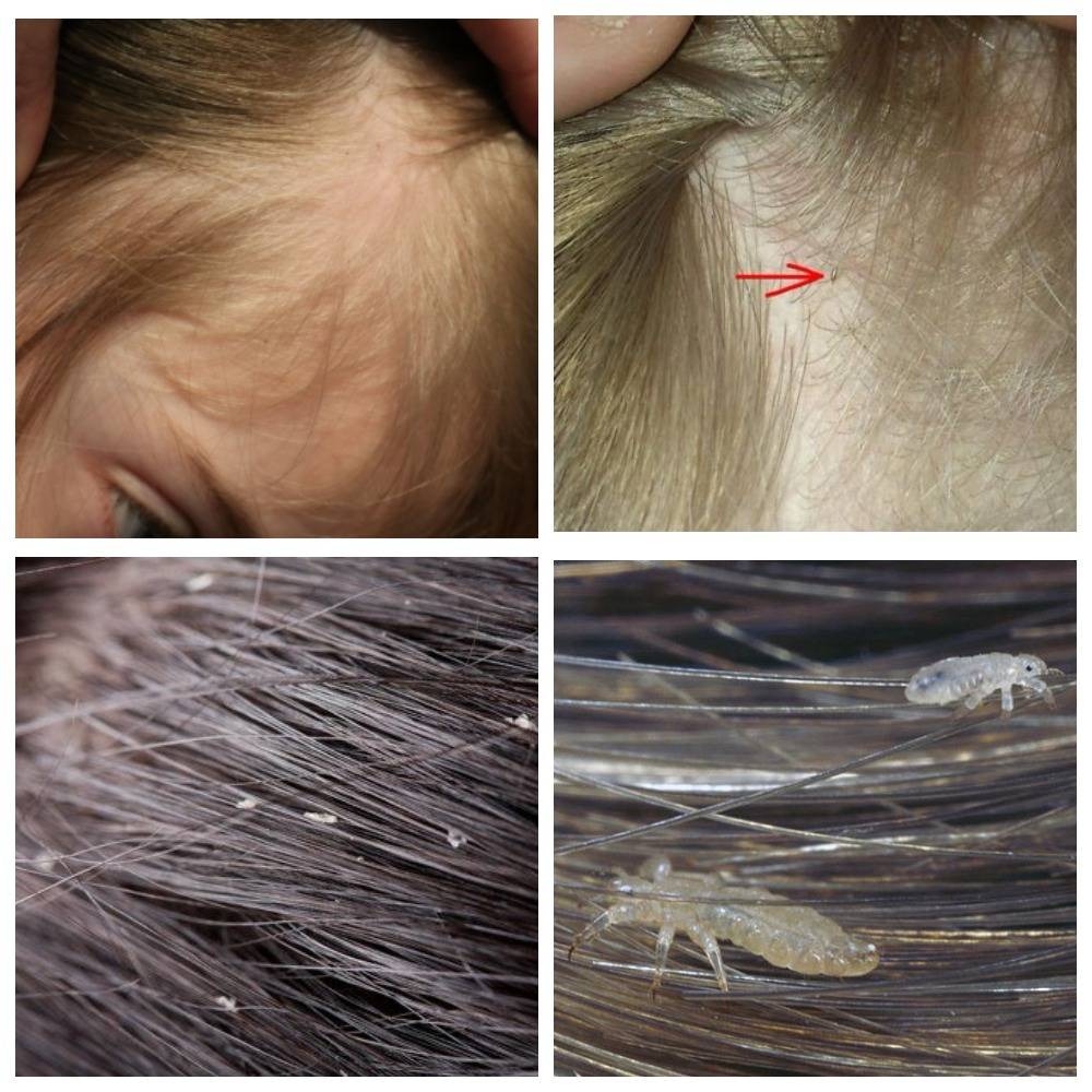 Как можно отличить перхоть от гнид на волосах