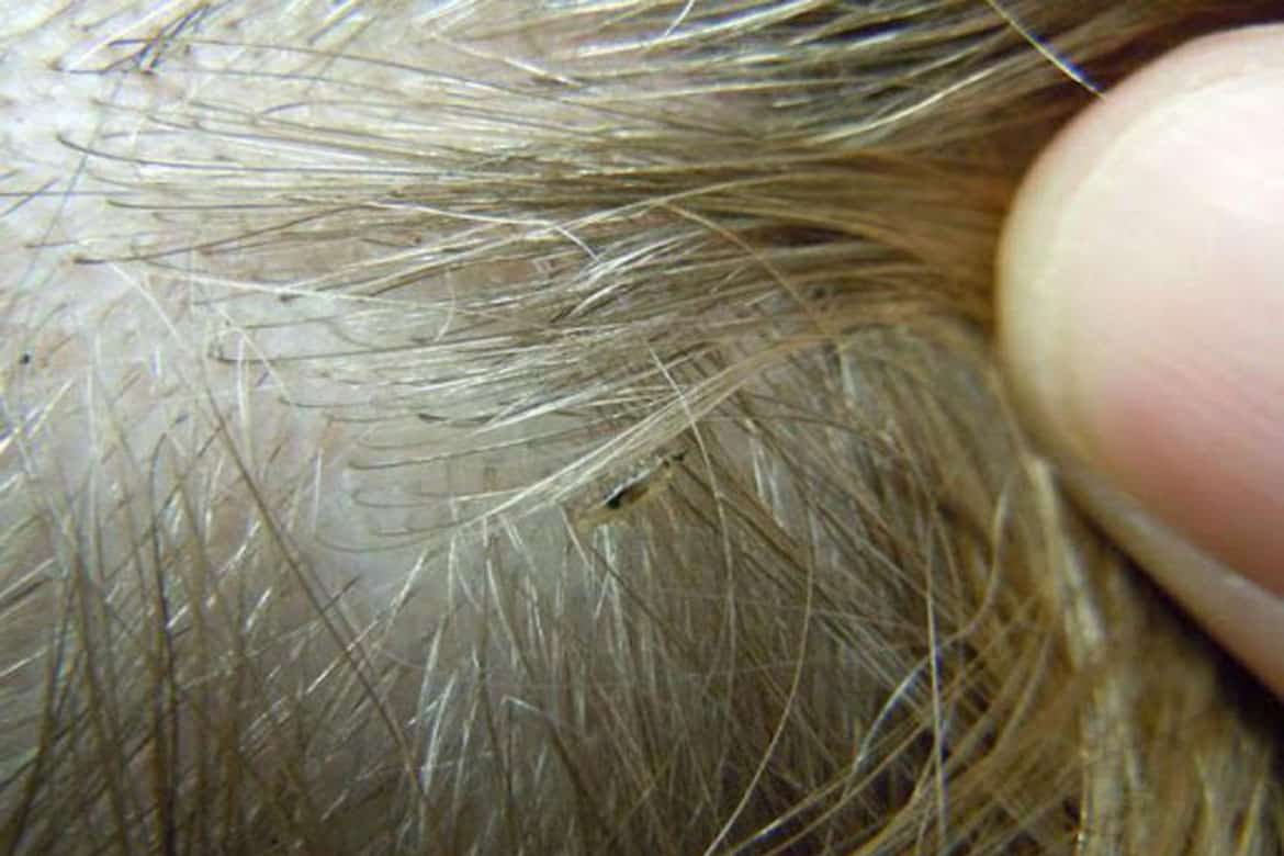 Головные вши и гниды в волосах: как выглядят, сколько живут вне головы + фото