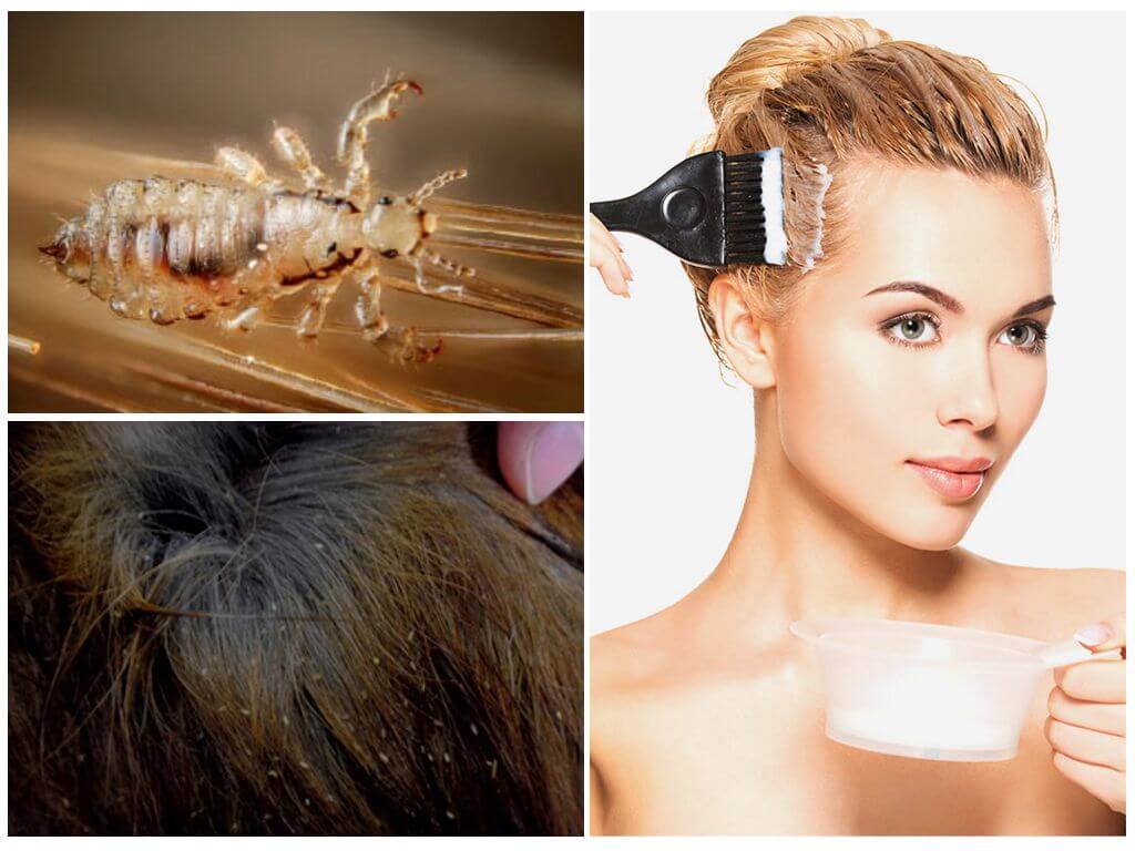 Как вывести вшей и гнид утюжком или щипцами для волос?