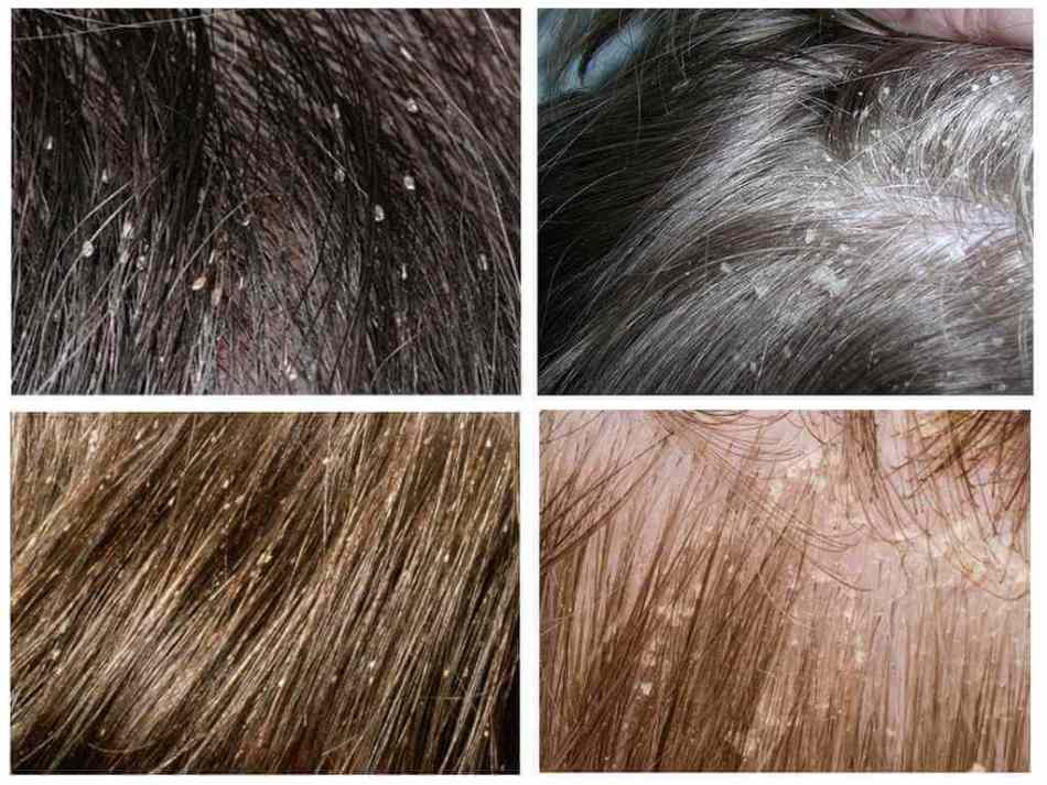 Убивает ли краска для волос вшей и гнид, советы эксперта