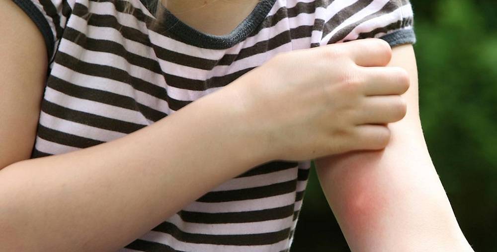 Чем помазать укус комара у ребенка: препараты от зуда