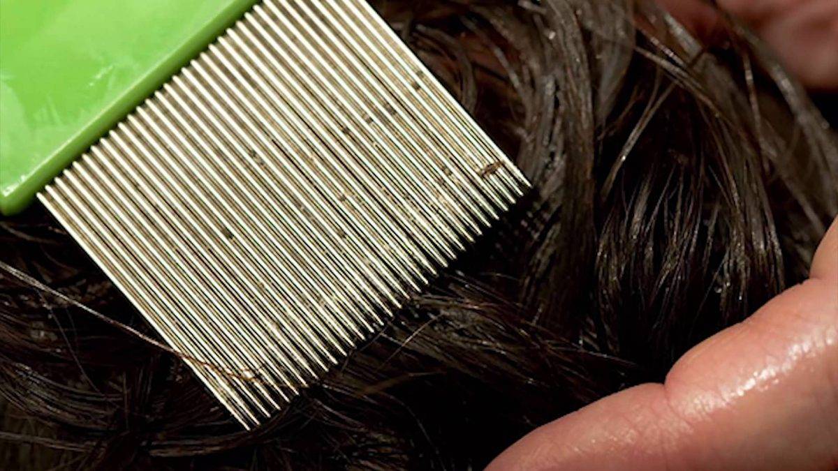 Убивает ли краска для волос вшей и гнид на самом деле?