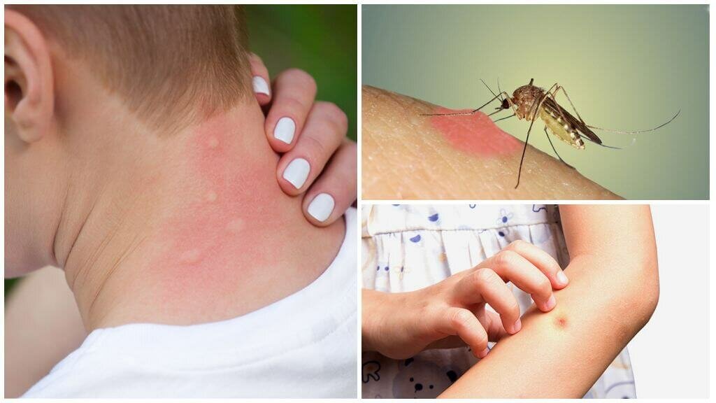 Укусы комаров: что делать с опухолью и покраснениями и как выглядит сам укус?