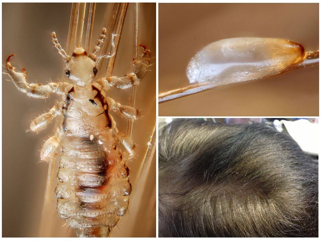 Чем опасны вши для человека на голове: переносимые вшами заболевания и вред от насекомых