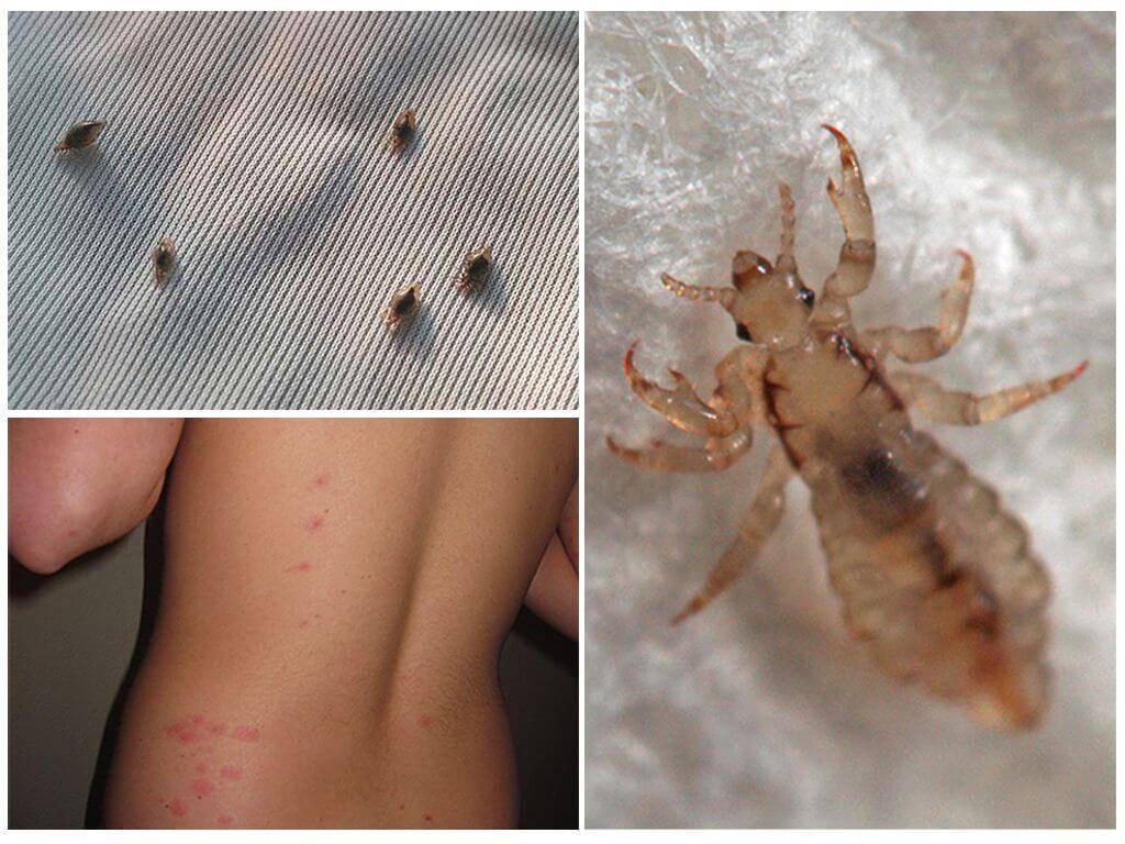 Бельевые вши: уничтожение насекомых от сэс: рекомендации по уничтожению от сэс