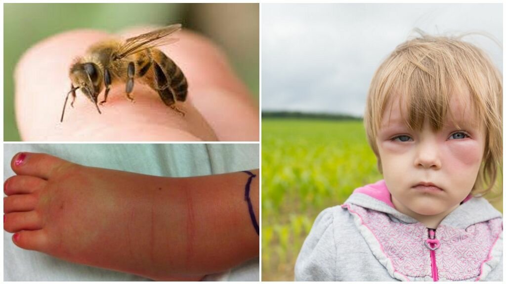Укусы насекомых: как оказать первую помощь и когда обращаться к врачу | рязань