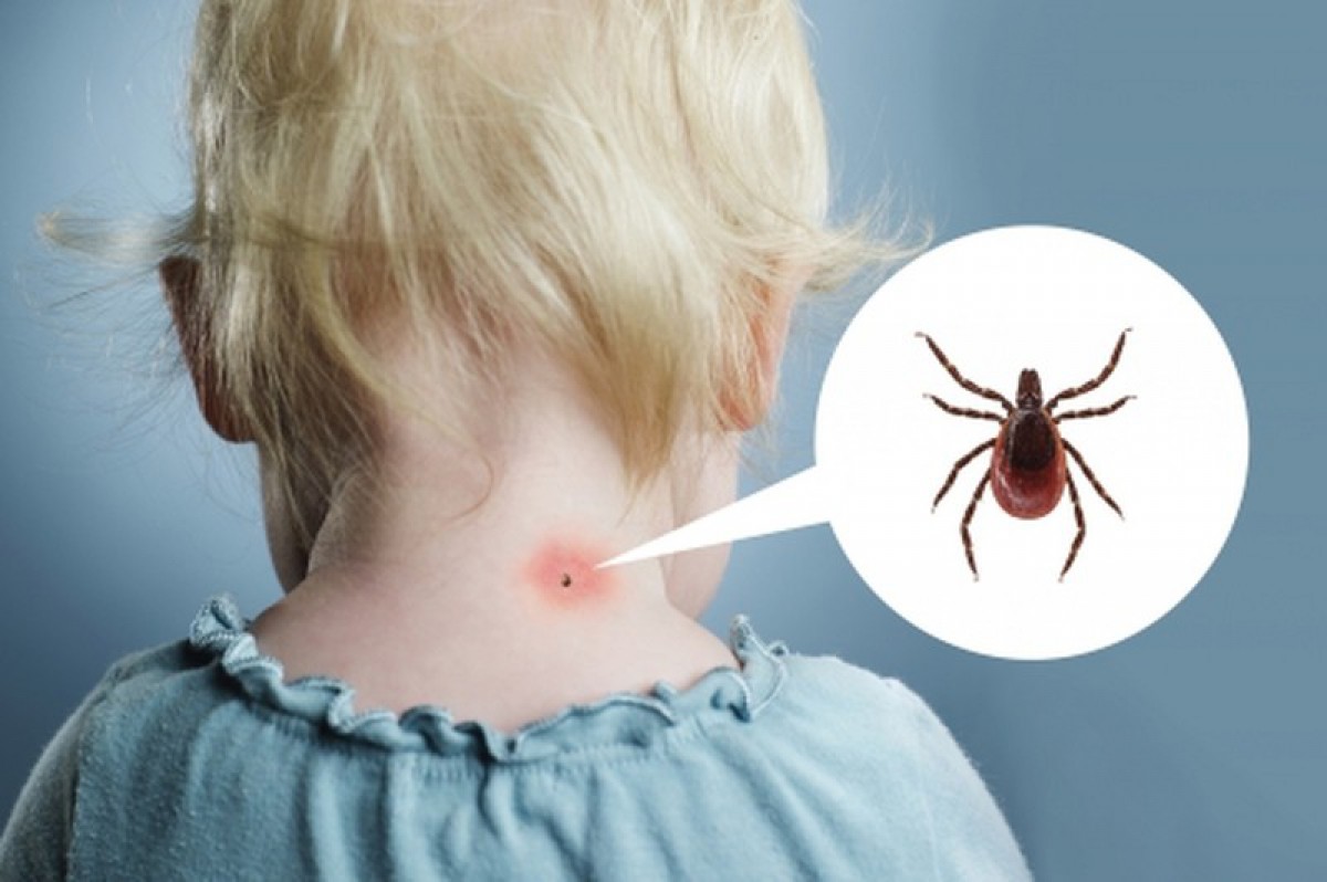 Аллергия на укус клеща: симптомы и лечение