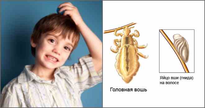 Вши и гниды: виды паразитов, пути заражения и цикл размножения, лечение и профилактика