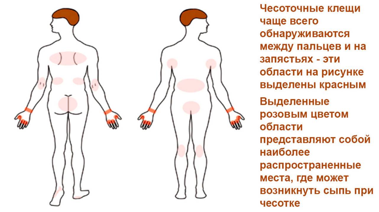 Чесотка: симптомы и лечение