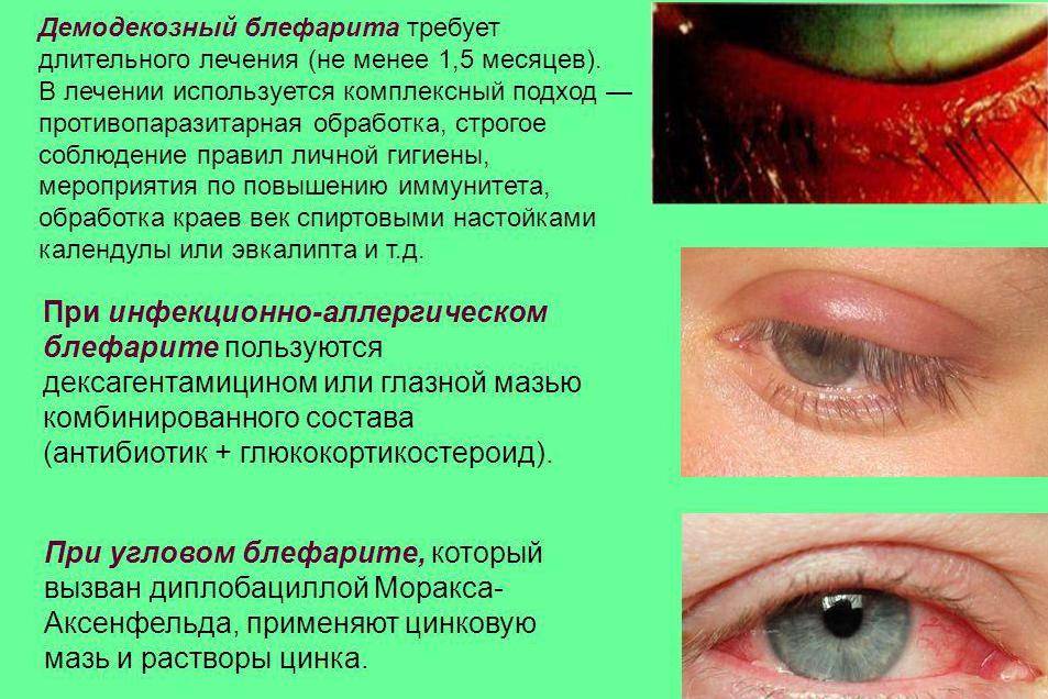 Демодекоз глаз | eurolab | научные статьи