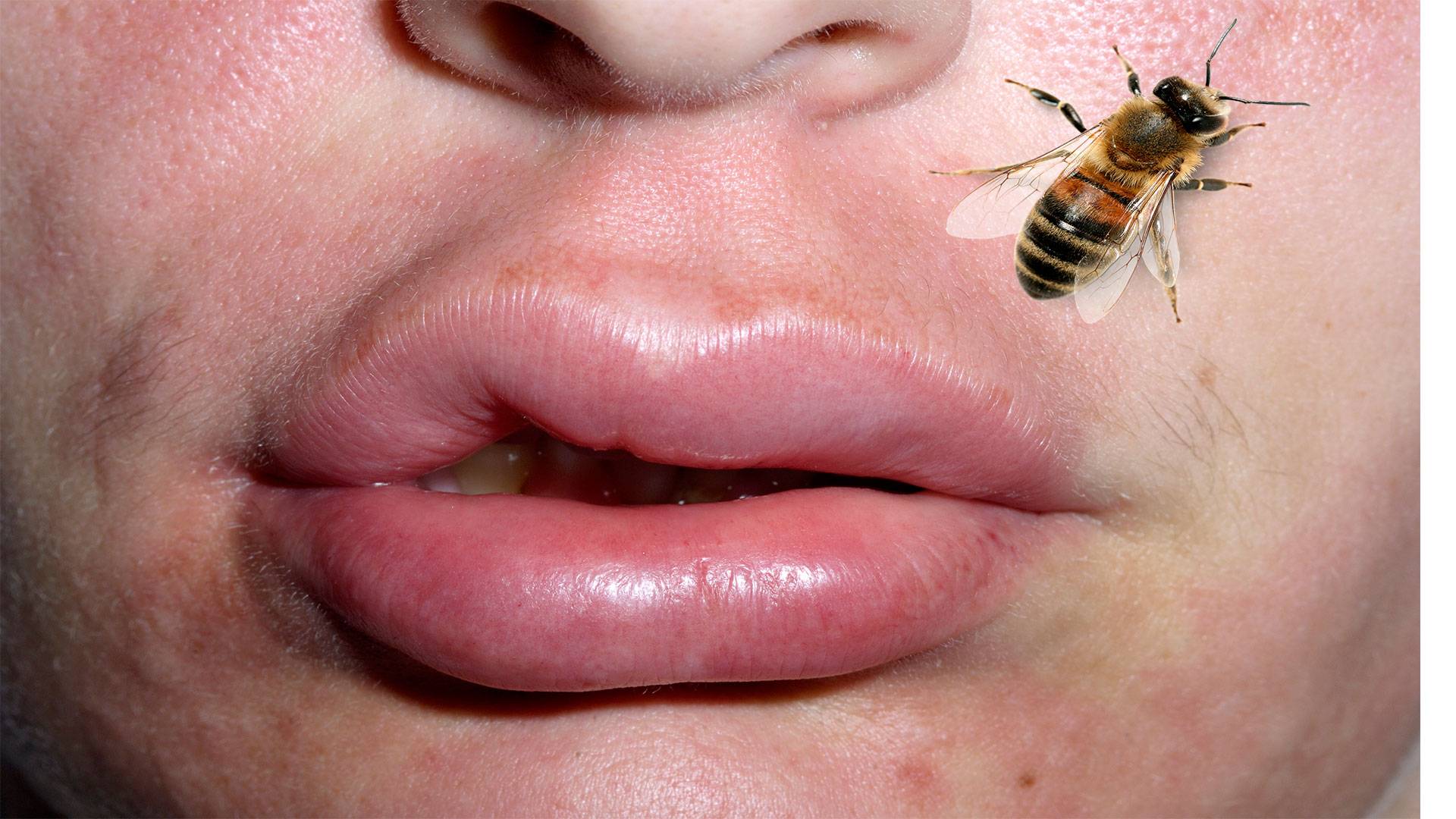 Как и чем снять отек при укусе пчелы: первая помощь