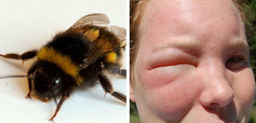Аллергия на насекомых: чем опасны укусы ос