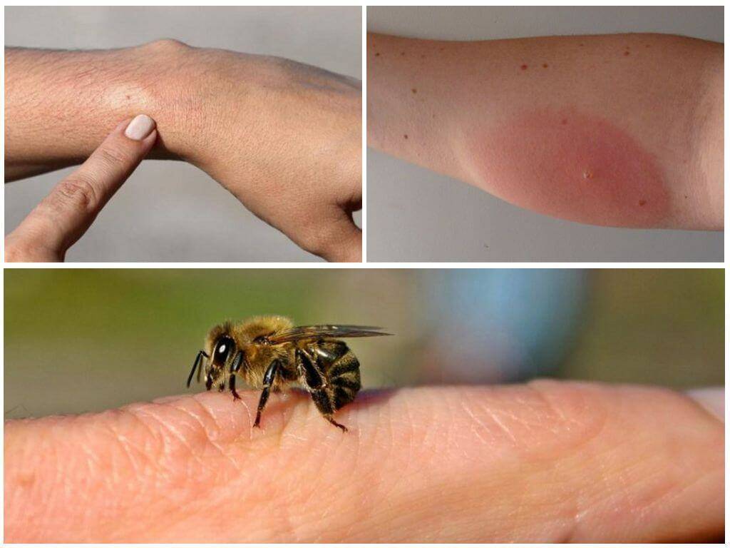 Что использовать для лечения укусов насекомых у детей