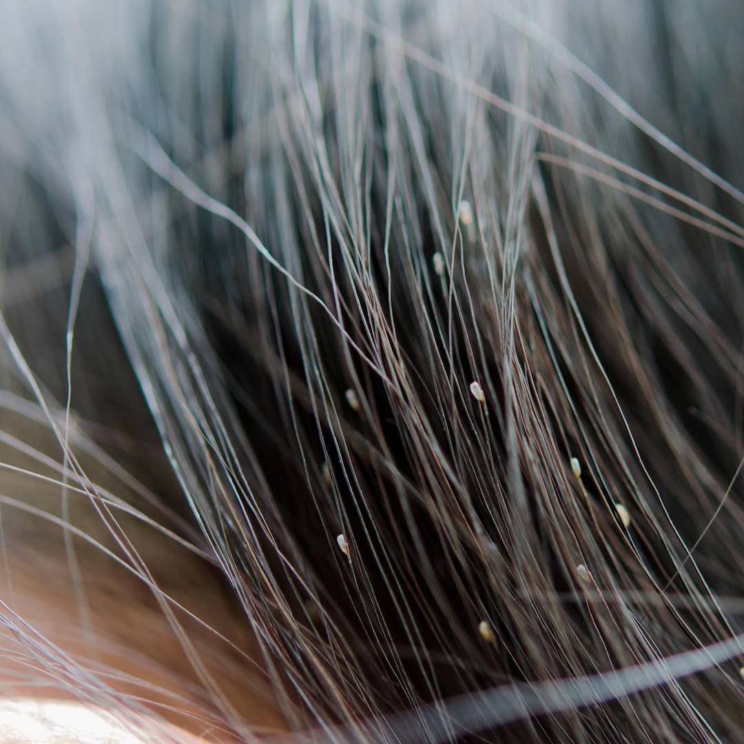 Гниды и вши в волосах: как они выглядят, инкубационный период. как вычесать гниды? | рутвет - найдёт ответ!