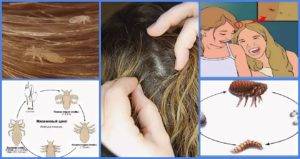 Обнаружить и удалить гниды на волосах: подробное описание, диагностика и  фото