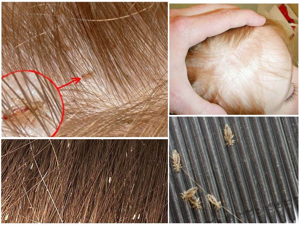 Окрашивание волос как способ избавиться от вшей