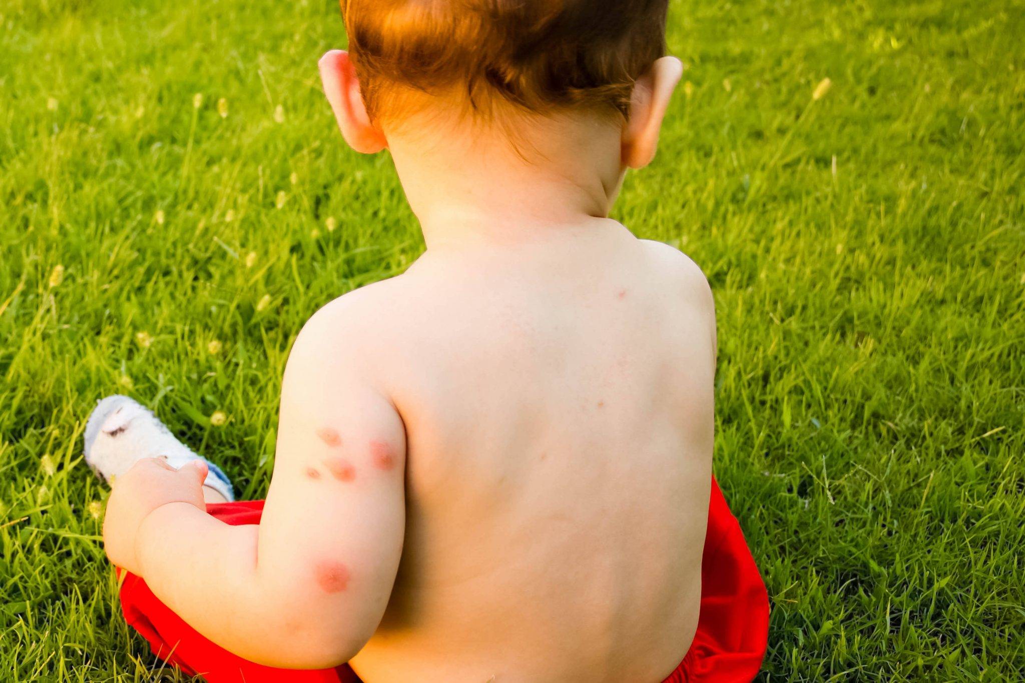 Аллергия на укусы клопов – симптомы у детей и взрослых
