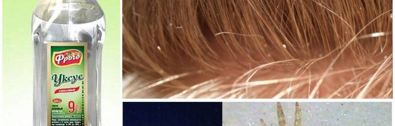 Полезная приправа от паразитов: как правильно развести уксус для ополаскивания волос от вшей и гнид?
