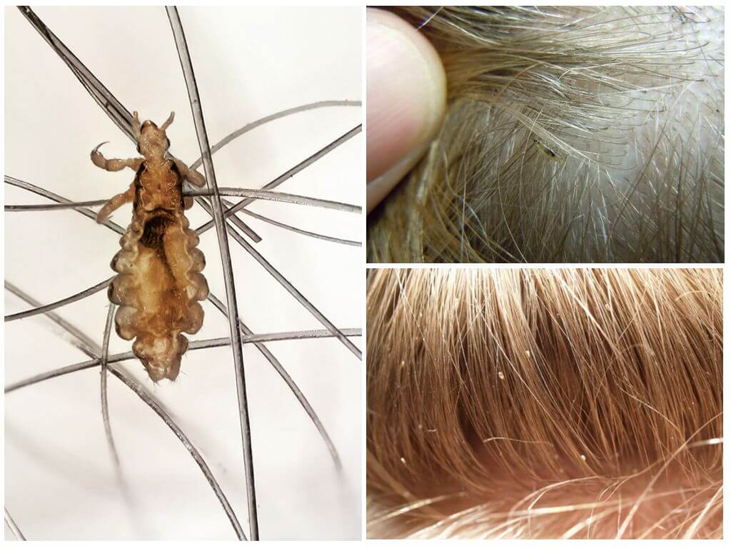 Живут ли вши на окрашенных волосах и можно ли их вывести краской