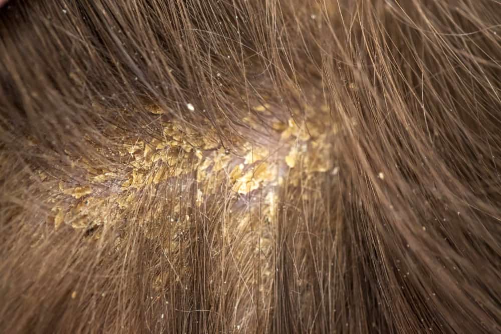 «зоопарк на голове» или как выглядят гниды на волосах у человека: описание и фото