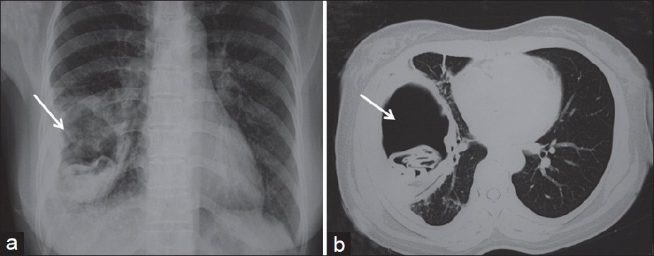 Пневмония: симптомы и лечение воспаления лёгких у взрослых и детей, профилактика заболевания