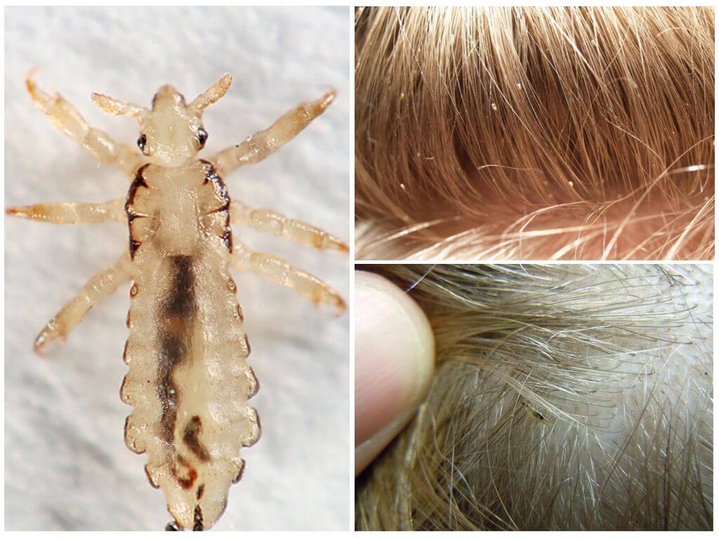Как могут выглядеть вши и их личинки