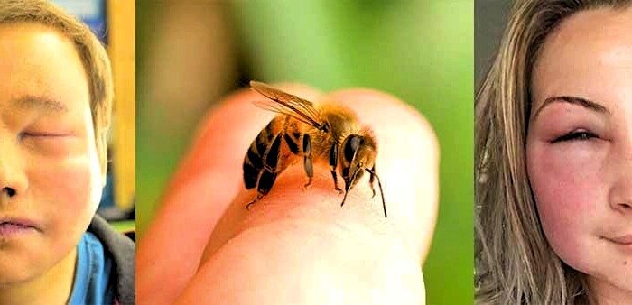 Когда и почему жалят пчелы. почему пчела умирает после укуса, извлечение пчелиного жала